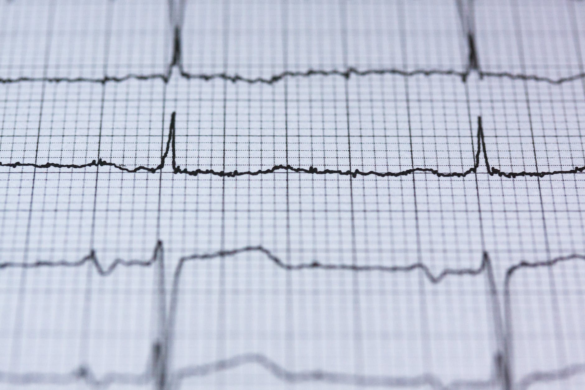 blur chart check up curve. ECGs can help to detect irregular heartbeat or cardiac arrhythmia
